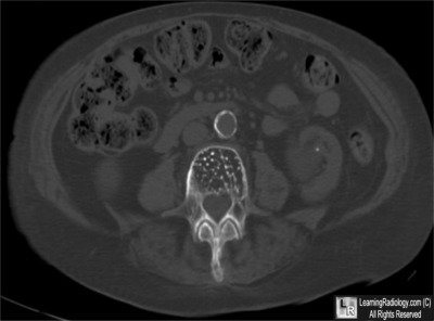 Hemangioma spine